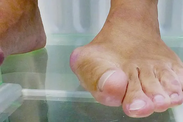 Hallux Valgus