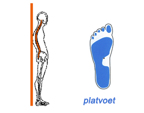 platvoet